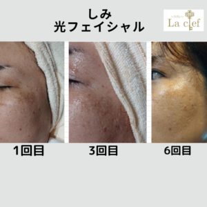 美肌効果のある光フェイシャルでシミとり Before Afterのご紹介 ラクレ 沖縄 糸満市潮平で脱毛 痩身 フェイシャルなら